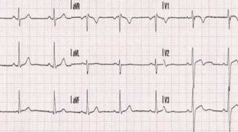 Kalp Ritm Kaydı (Holter Monitoring)